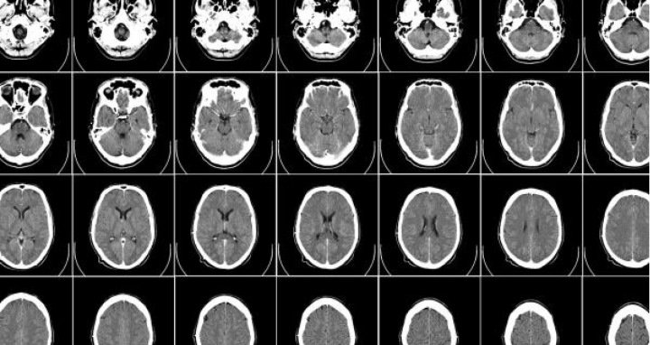 倫敦國王院透過Cambridge-1 超級電腦與AI框架MONAI建立100,000張3D人腦合成圖像，協助研究各種腦部疾病。